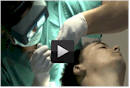 dhi hair transplant videos