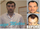 dhi hair transplant before and after photos
