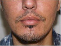 beard hair transplant