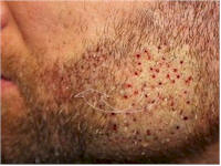 beard hair transplant