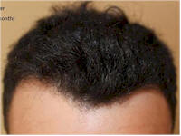 hair transplant photos belgium