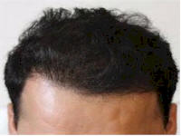 belgium hair transplant patient