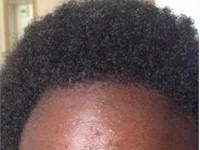 black women hair loss