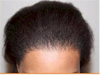 black female hair transplant