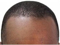 black hair transplant patient
