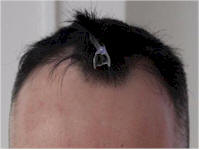 dr mwamba hair transplant gallery
