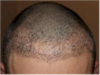 dr mwamba hair transplant repair