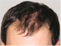 hair transplant gallery 