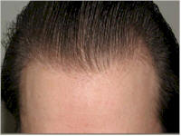 hairline repair belgium