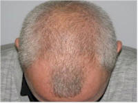 norwood 6 fue hair transplant