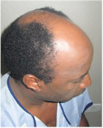 african hair transplant