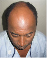 fue for african hair