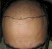 asian hair transplant photo