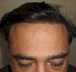 dr bhatti hair transplant photos