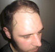 hair restoration uk