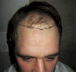 baldness treatment