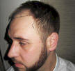 alopecia photos
