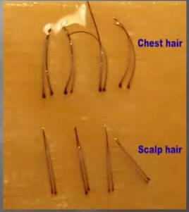 fue body and beard hair grafts