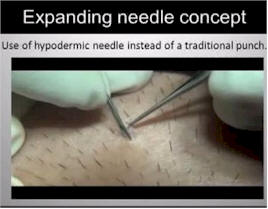 fue hair transplant expanding needle