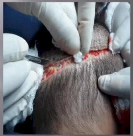 bad fue hair transplant 