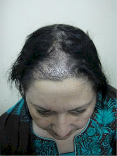 women hair transplant pakistan