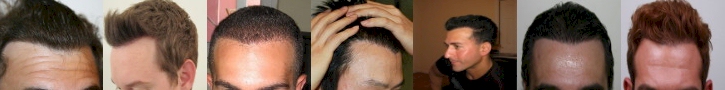armani hairlines
