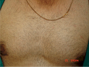 body hair transplant