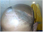 hair transplant repair