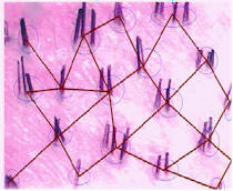 hair transplant donor