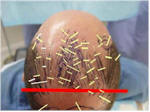 hair transplant