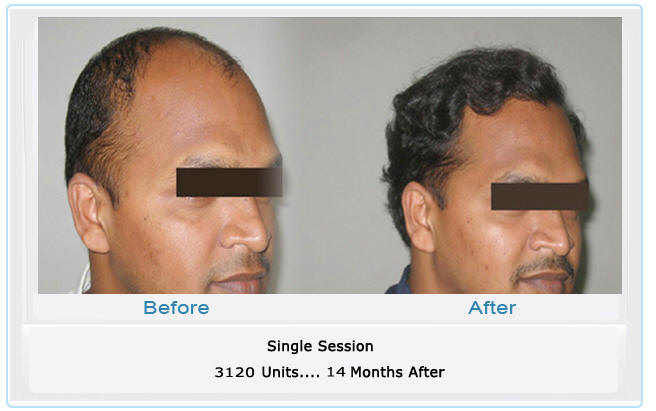 dr madhu hair replacement photos