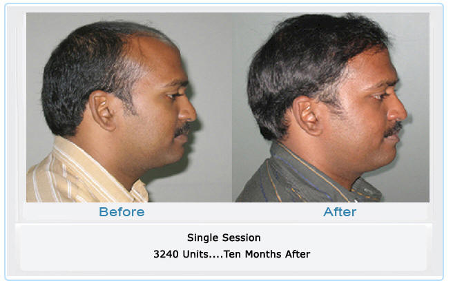 dr madhu hair transplant photos