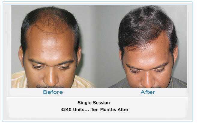 dr madhu hair transplant pictures