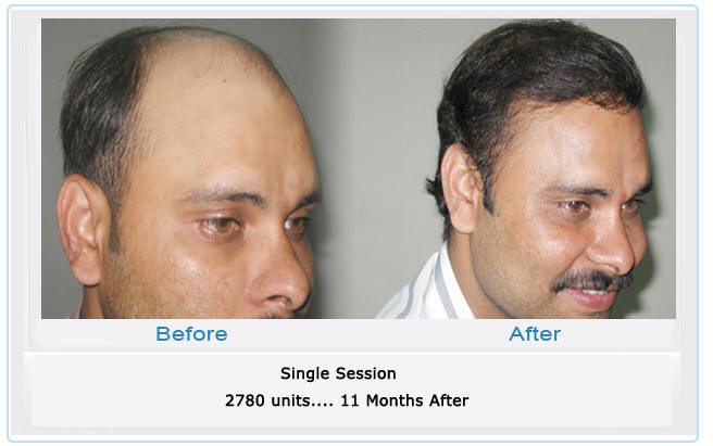 dr madhu hair transplant results