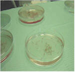 PRP Platelet Rich Plasma Hair Growth