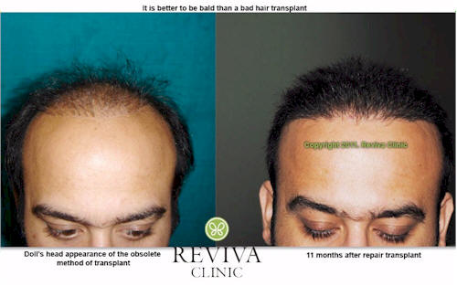 Hair Transplant Clinic in India Reviva Hair Transplant Clinic