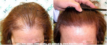 women hair transplant UK 