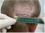 acell wound regeneration